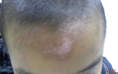 头部白斑早期症状图片