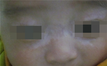 小孩缺维生素脸上白斑图片
