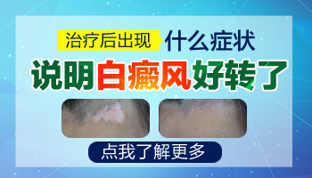 白癜风照308激光好转的征兆是长黑色素岛吗