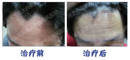 白癜风的治疗费用预计有多少