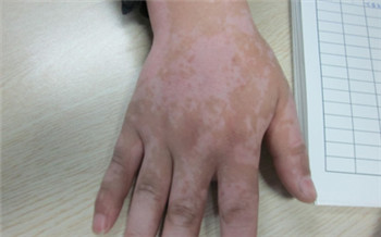 手上突然出现白斑图片