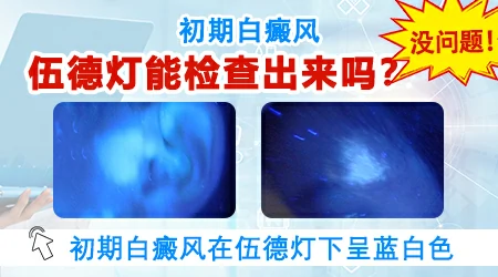 初期白癜风伍德灯能照出来吗