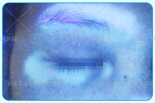 眼周白癜风图片 眼角早期白癜风症状