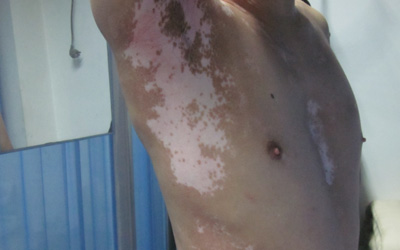 腋下淡白色的斑点是白癜风吗