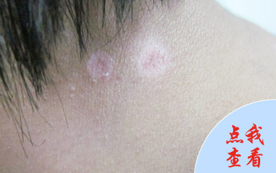 背上白斑的早期图片 长白斑是白癜风吗