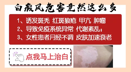 头皮上的白癜风会不会导致斑秃