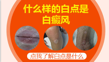 女人脸上有白斑图片 白斑是白癜风吗
