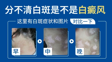 肚子上长了块白的斑块会不会越来越大