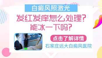 白癜风照完308激光能立即洗澡吗