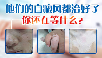 青少年手上白斑早期的图片