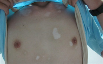 小孩胸前有块白斑以前不明显现在越来越明显