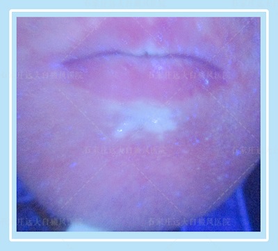 两个月宝宝下巴比别的地方白是怎么回事