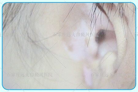 三岁宝宝耳朵旁边发白图片