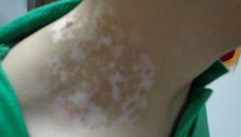 脖子上出现好多白点是什么疾病