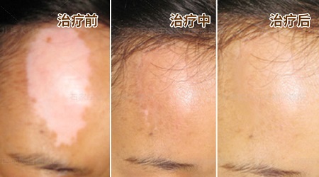初期白癜风能治好吗 白斑发病的原因是什么