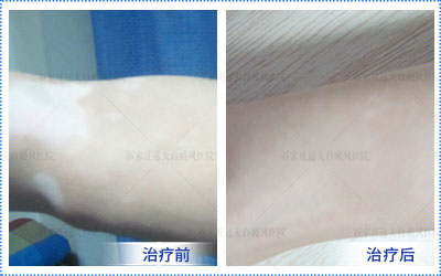因气血不足引起的白癜风怎么治