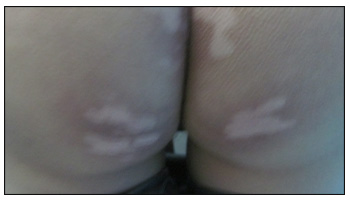 隐私部位白癜风