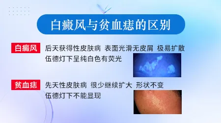 白癜风图片鉴别与区分 贫血痣和白癜风怎么看图分