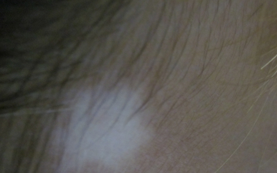 早期脸部白癜风的识别图