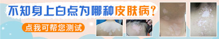 女孩白斑初期照片 白斑是白癜风吗