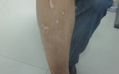 腿上有小白点半个月了怎么回事