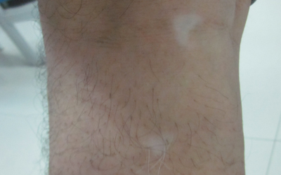 大腿内侧白斑点是什么原因