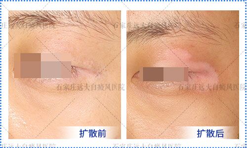 脸上有白斑怎么遮盖 长白斑是怎么回事