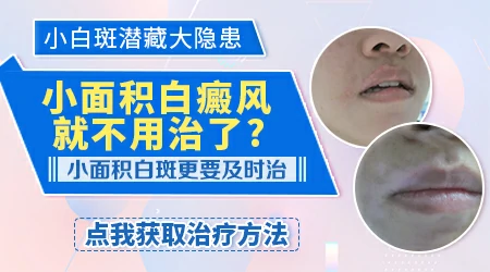 小面积白斑能治愈不复发吗