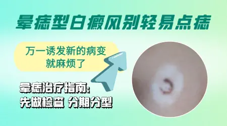 晕痣的中央痣可以用点痣药水去掉吗