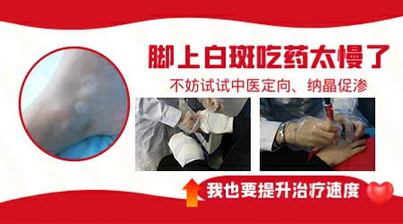 脚上的白癜风为什么没有脸上的好转快