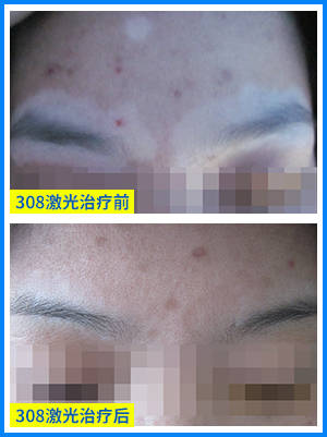 308激光能治好白斑吗 治白癜风几次见效