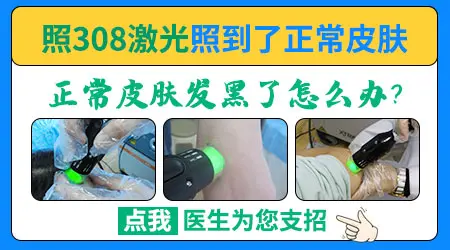 白癜风308光疗照多了导致周围皮肤变黑能退掉吗