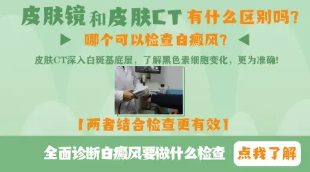 皮肤镜和皮肤ct哪个判断白斑更准确
