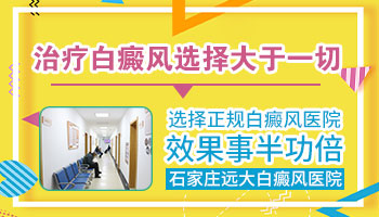 石家庄白斑怎么治疗 白斑治得好吗