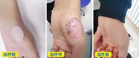 中医治疗白癜风得多长时间起效