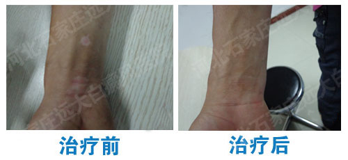 胳膊上有个米粒大小的白斑是什么