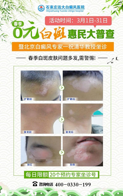 白癜风一般从哪个地方出现