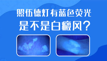 伍德镜检查白斑为蓝白色是不是白癜风