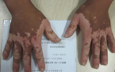 手指末端白癜风图片