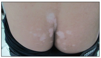 肛周白斑的早期症状 长白斑的原因有哪些