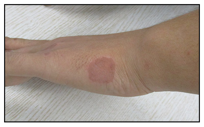 照完308后皮肤红一个月了是什么原因