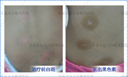 白癜风照光复色过程图片