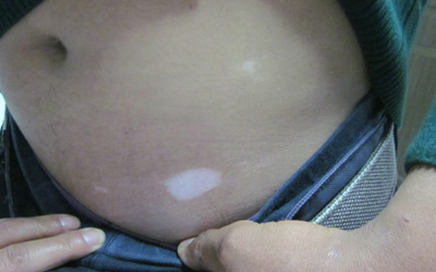 肚子上出现白斑 白斑是什么图片对比