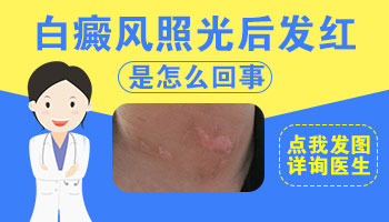 白癜风照308激光后发红多久会好