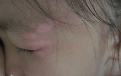 孩子眼睛周围白怎么回事