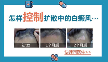 如何避免身上别的位置再长白癜风