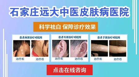 民间治疗白斑病偏方 白斑ZUI好的恢复方法