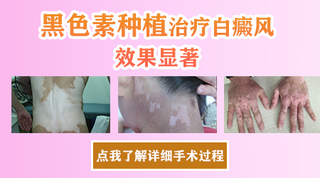 黑色素种植治白斑的效果好吗 手术需要多少钱