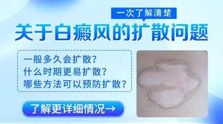 白癜风一定会扩散吗 扩散速度有多快
