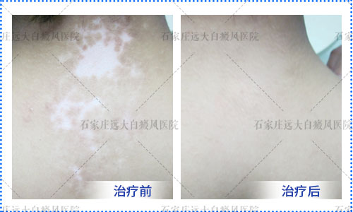 皮肤白斑复色需要多久 治好白斑花多少钱